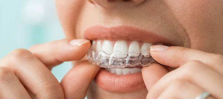 Patientin setzt eine transparente Aligner-Zahnschiene zur unsichtbaren Zahnkorrektur ein.